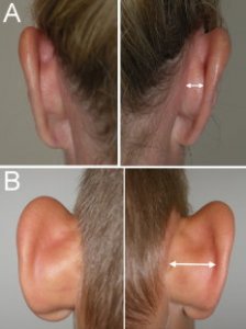 Ytre_ore_patient_A_normal_ear_cartilage_patient_B_excess_cartilage_growth_contributing_to_prot...jpg