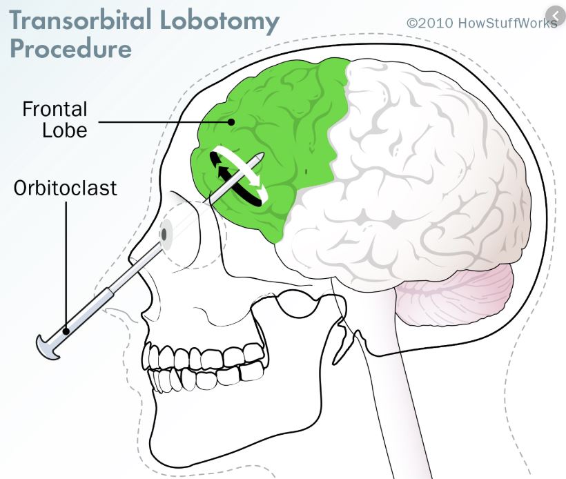 lobotomized.JPG