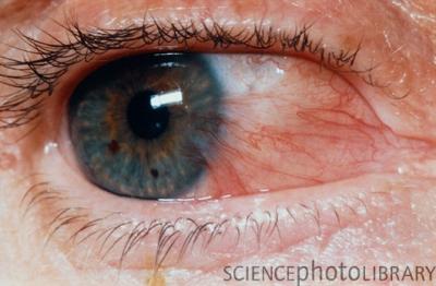 Pterygium_of_the_eye.jpg