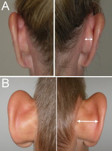 Ytre_ore_patient_A_normal_ear_cartilage_patient_B_excess_cartilage_growth_contributing_to_protru.jpg