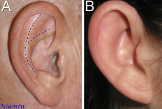 Ytre_ore_patients_normal_antihelical_fold_A__without_developed_antihelical_fold_B.jpg