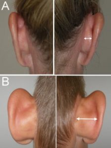 Ytre_ore_patient_A_normal_ear_cartilage_patient_B_excess_cartilage_growth_contributing_to_protru.jpg