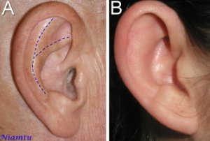 Ytre_ore_A_Patients normal antihelical fold_B_Without developed antihelical fold.jpg