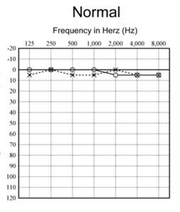 normal hørsel.PNG